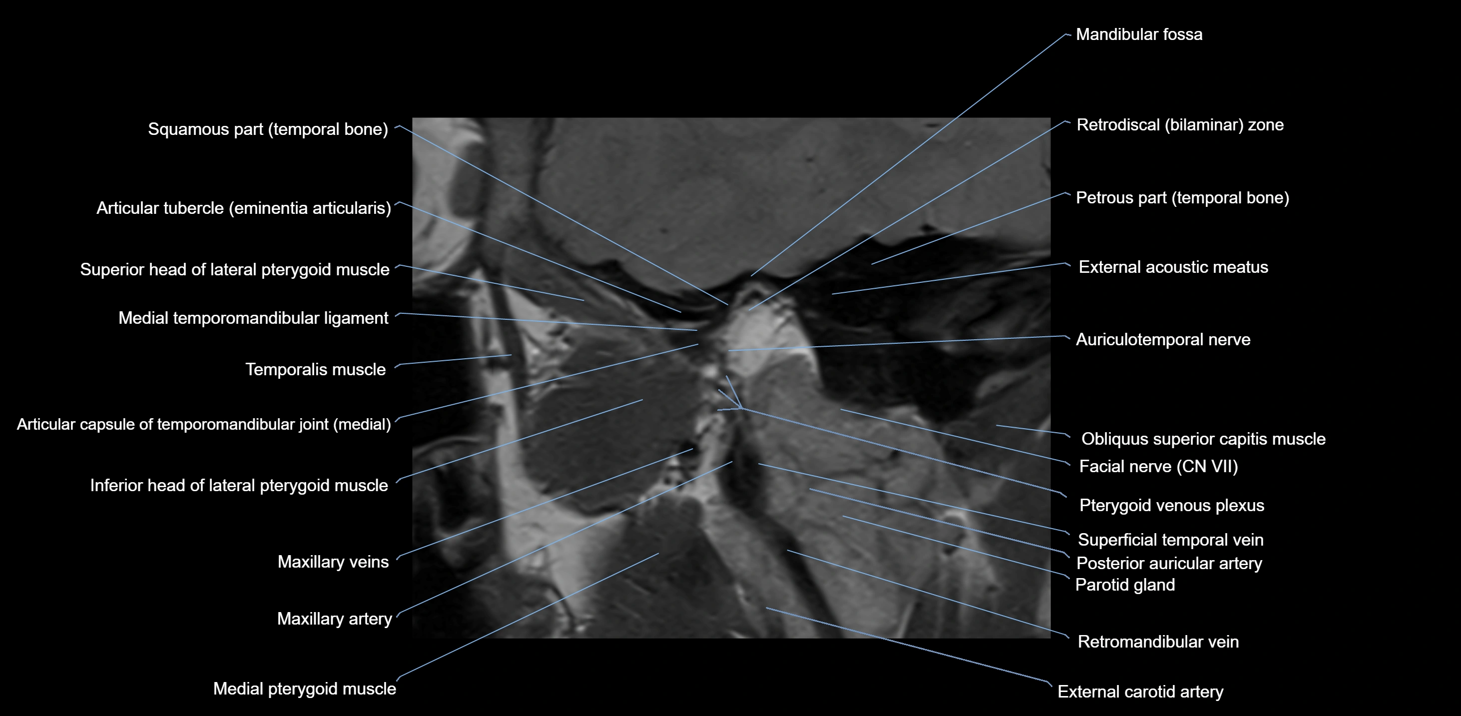 MRI TMJ sagittal open  mouth cross sectional 3T anatomy -img-00001-00011.webp